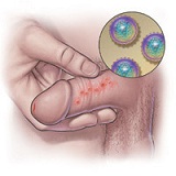 Genitalherpes