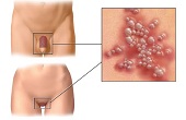 Genital Herpes